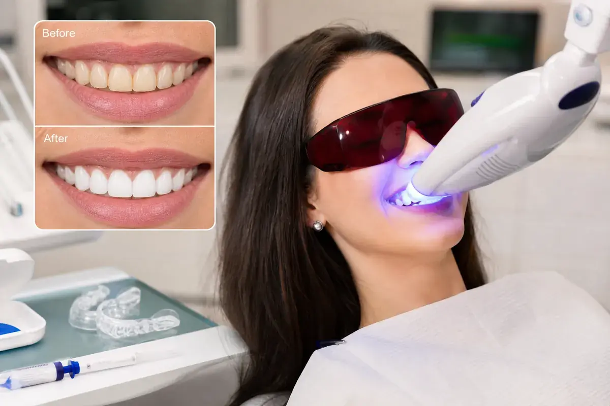Teeth Whitening – Brilliantly White Teeth – Zahnarztpraxis Spring Berlin-Tegel