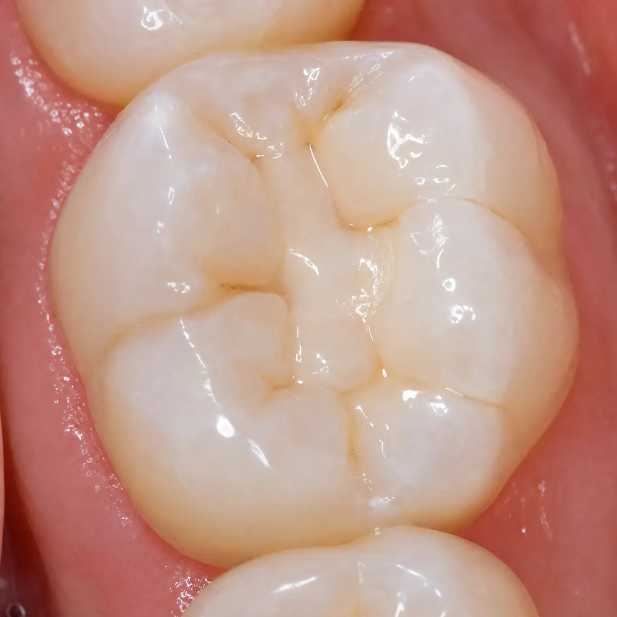 Broken Molar – CEREC Crown: result after CEREC ceramic restoration