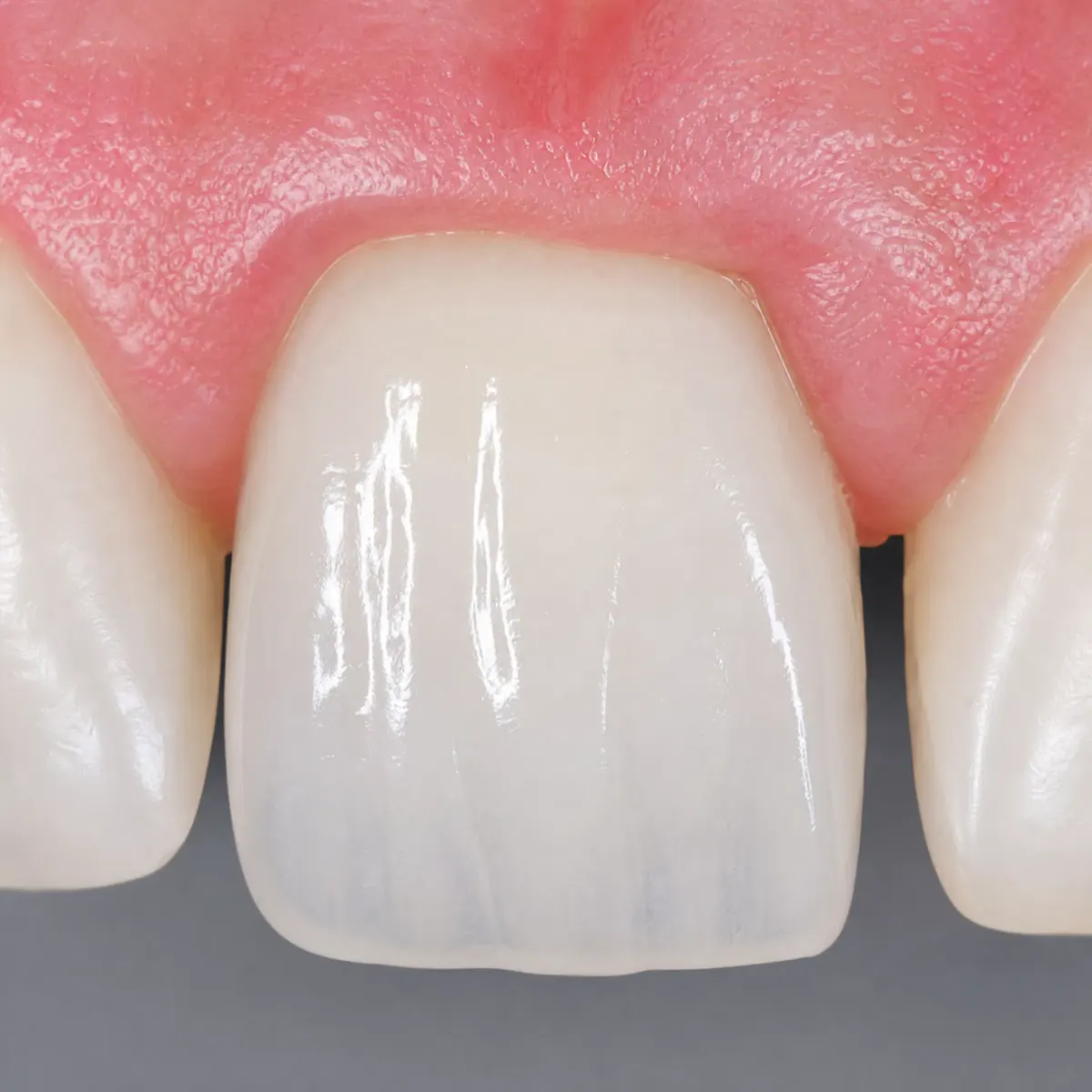Front Tooth Veneer with CEREC: result after CEREC ceramic restoration