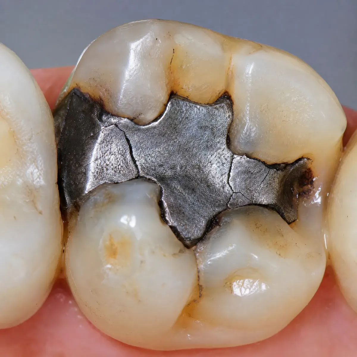 Amalgam Replacement with CEREC Inlay: initial situation before CEREC treatment