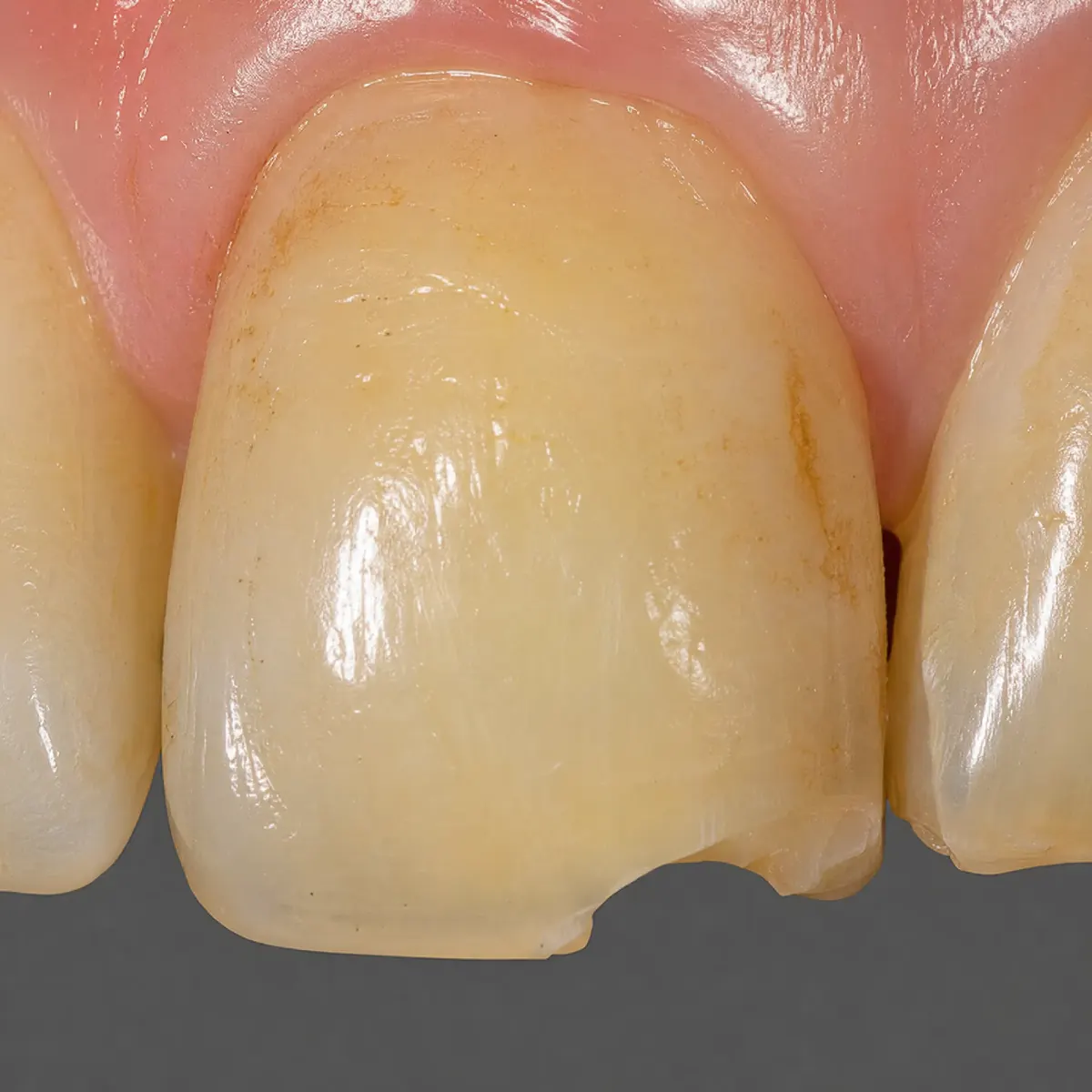 Front Tooth Veneer with CEREC: initial situation before CEREC treatment
