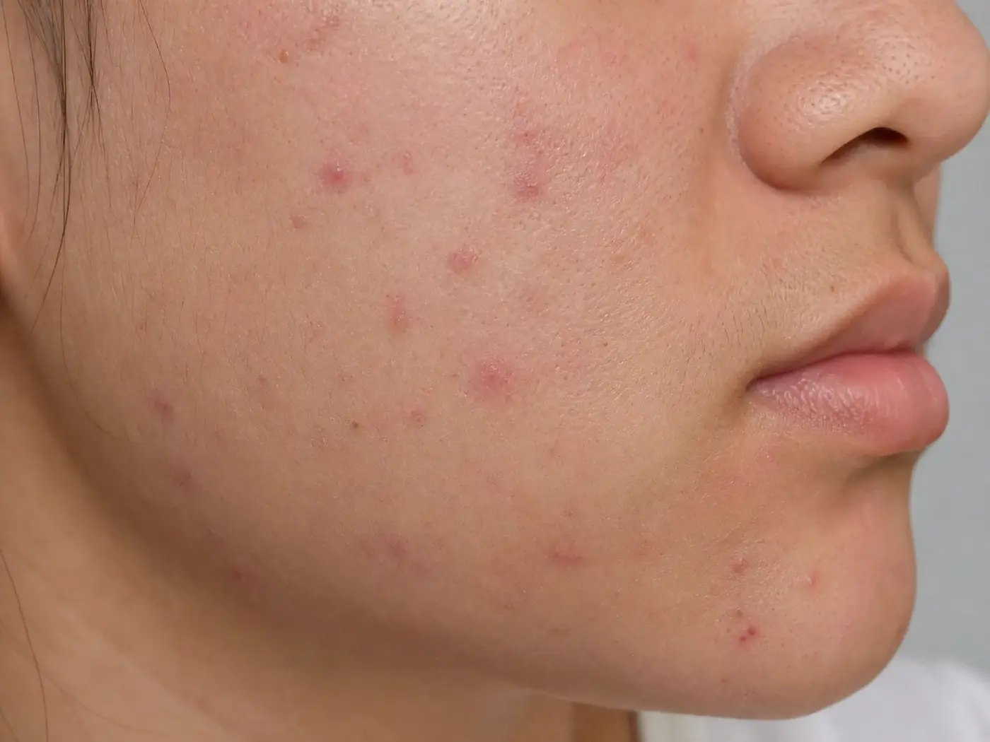 Skin concerns and the gut-skin axis – naturopath Berlin Blemished skin illustrating counselling on the gut-skin axis with Isabelle Spring