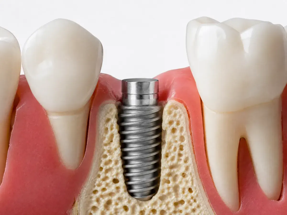 Implantology – Zahnarztpraxis Spring Berlin-Tegel